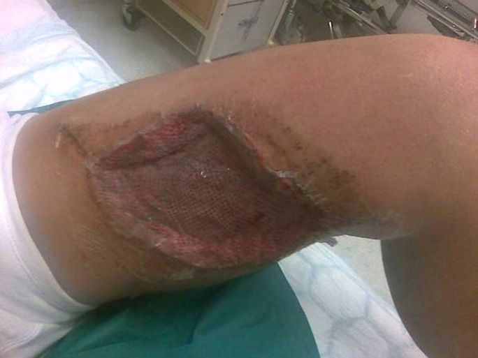 A bad case of polar thigh. 