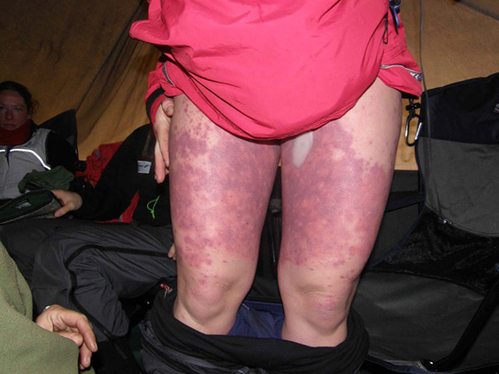 A milder case of polar thigh. 