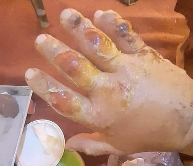 Denis Urubko's frostbitten hand