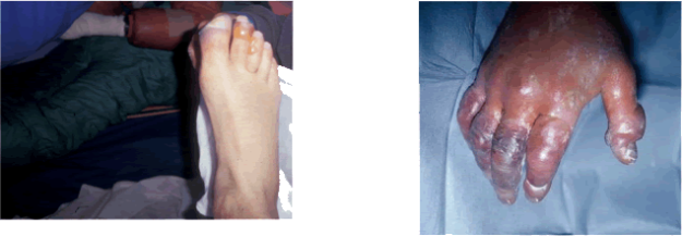 A blistered toe and purple, swollen fingers.
